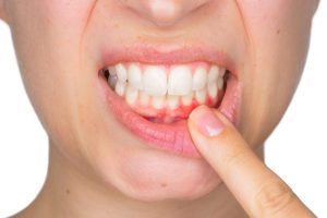 Gingivitis vs. Periodontitis: Understanding the Difference and Safeguarding Your Smile
