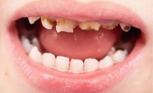 What Are Some Common Dental Problems in Children?